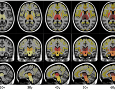 IA et sclérose en plaques